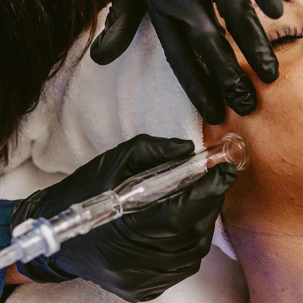 Image of a microneedle service at Lusso Hair Studio & Spa located in Winston-Salem, NC.